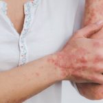 psoriasis-5996424